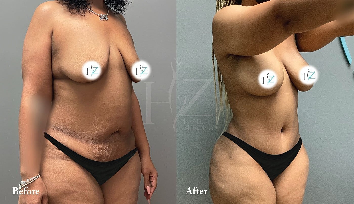 Transformation before and after plastic surgery.