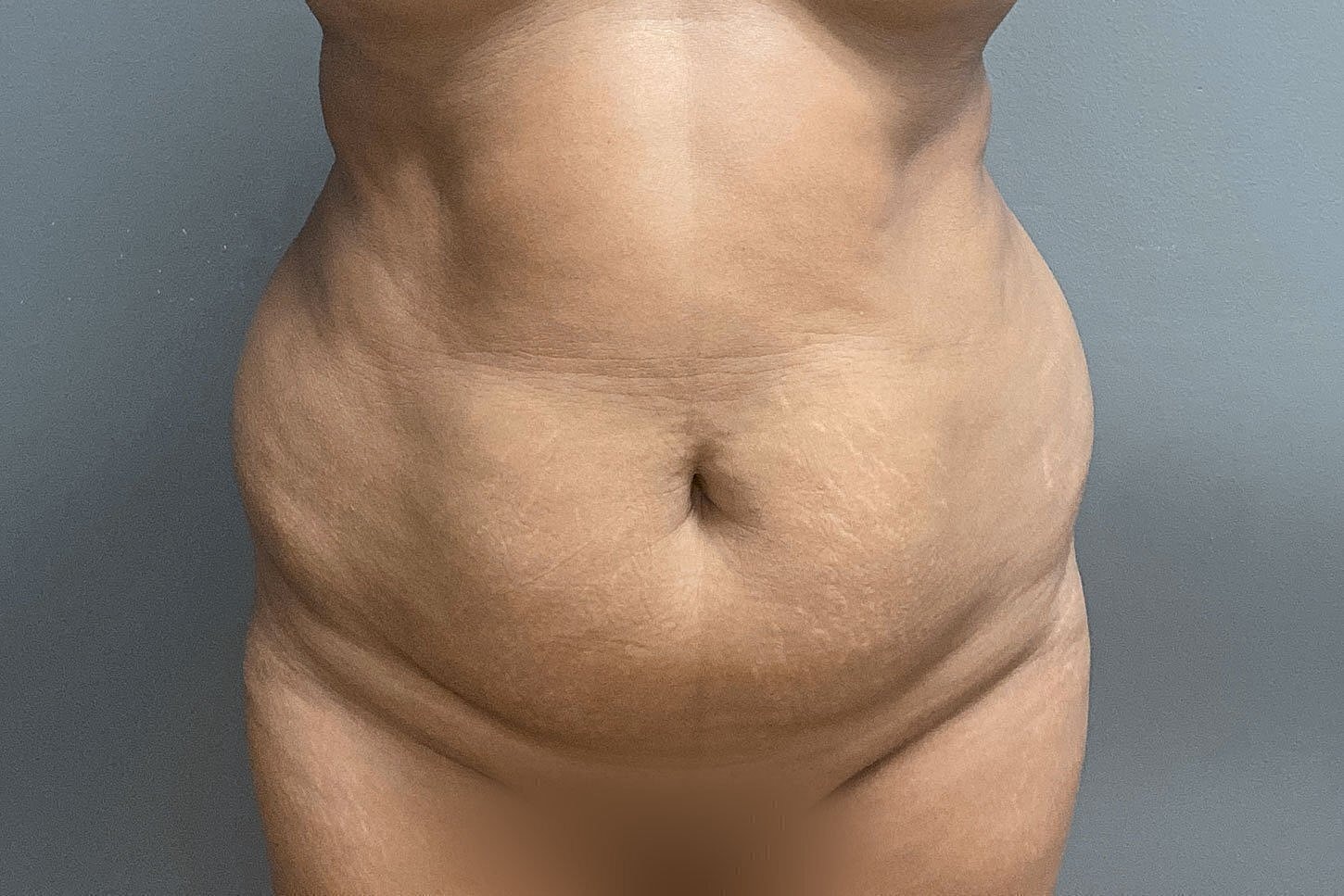 Image of a bare abdomen with visible skin texture.