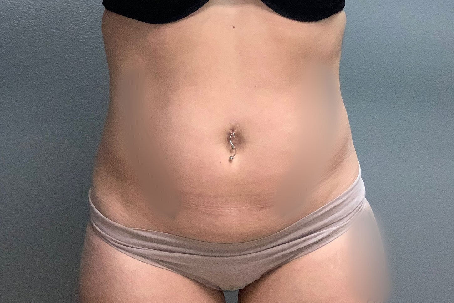 Abdomen with belly button piercing and stretch marks.