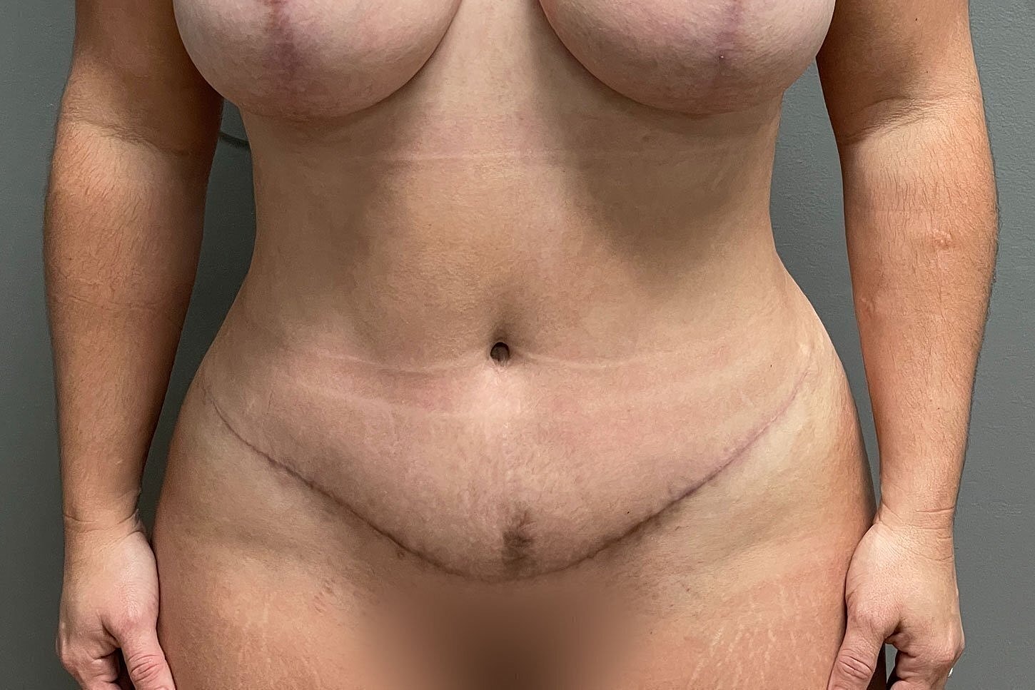 Post-surgery body with visible scarring and stretch marks.