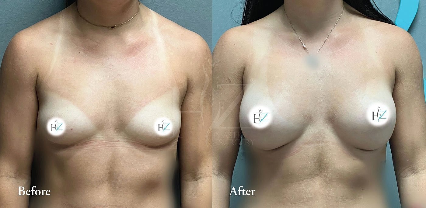 Before and after breast enhancement comparison image.