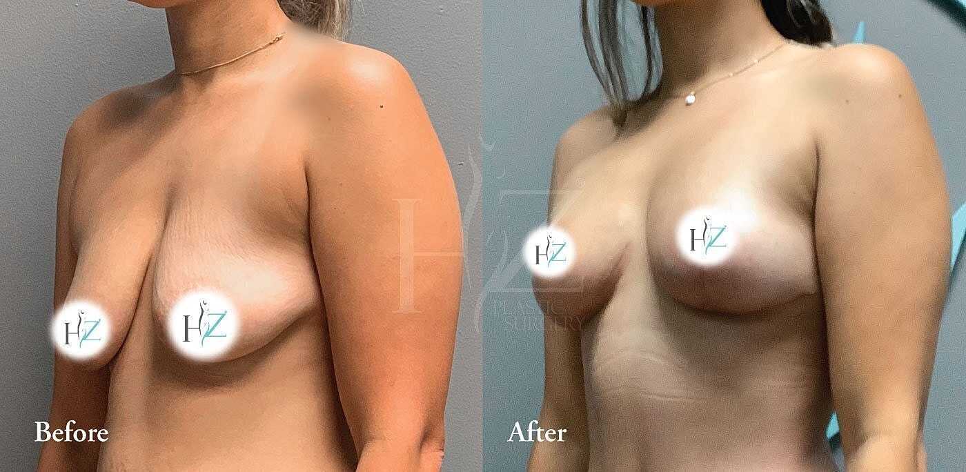 Before and after breast enhancement transformation.