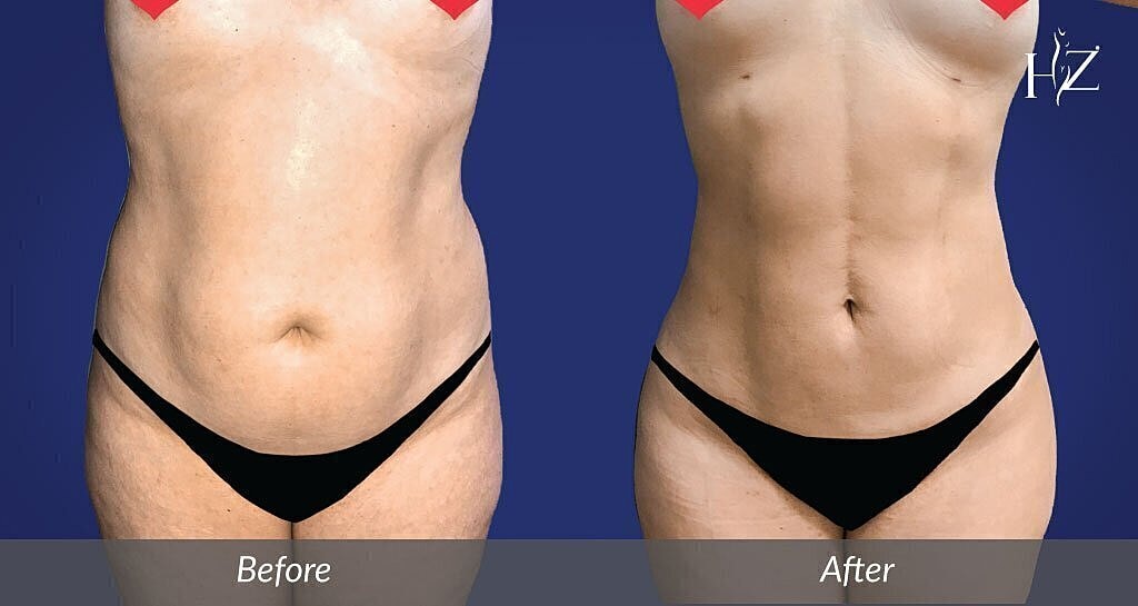 Body transformation before and after comparison.