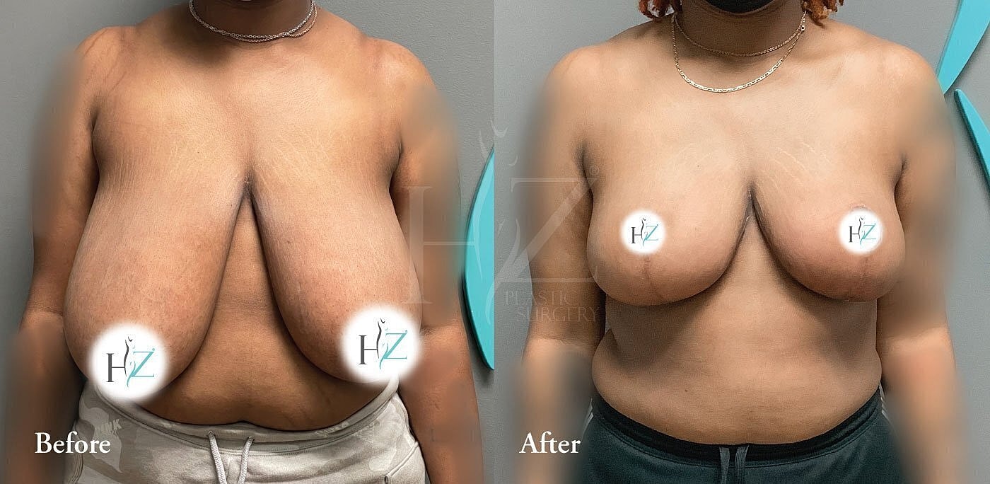 Breast enhancement before and after photos.