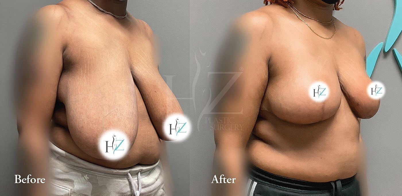 Before and after breast surgery transformation.