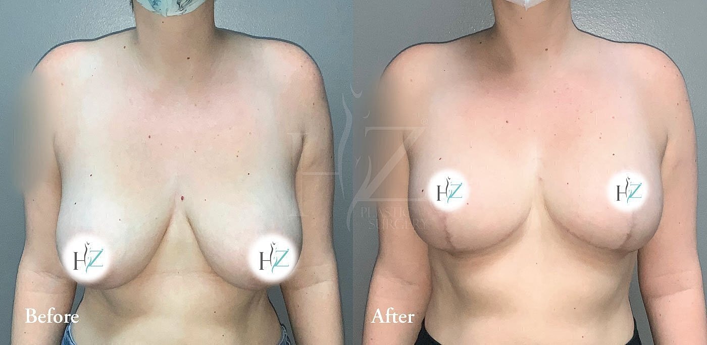 Breast augmentation before and after photos.