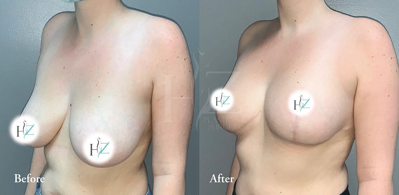 Before and after breast enhancement side view.