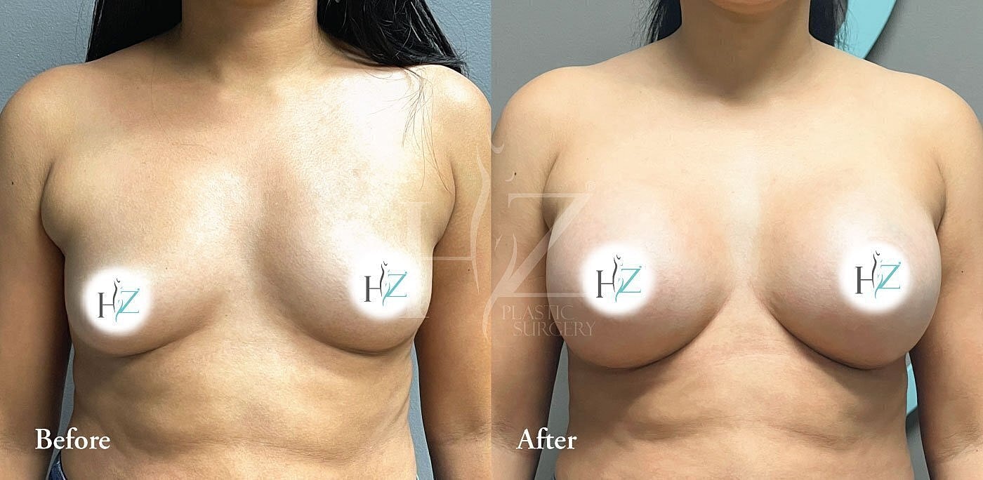 Breast enhancement before and after surgery comparison.