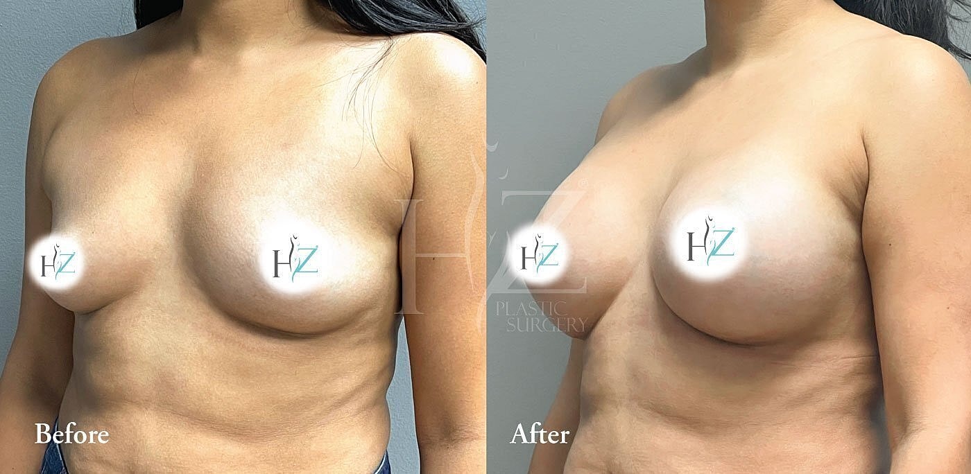 Breast augmentation before and after comparison.