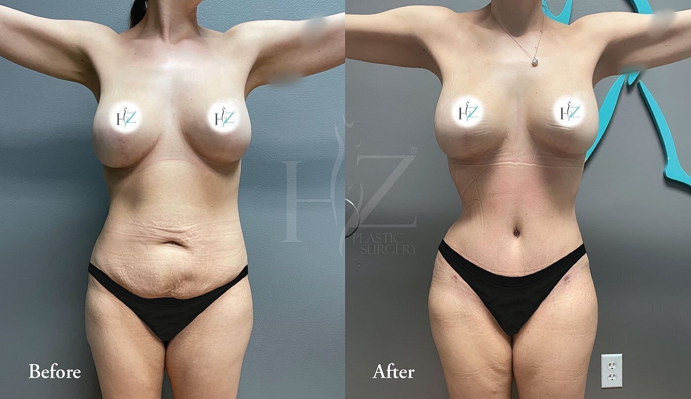 Before and after plastic surgery transformation.