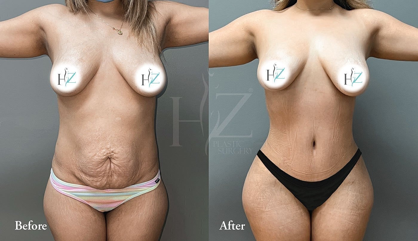 Before and after plastic surgery transformation.