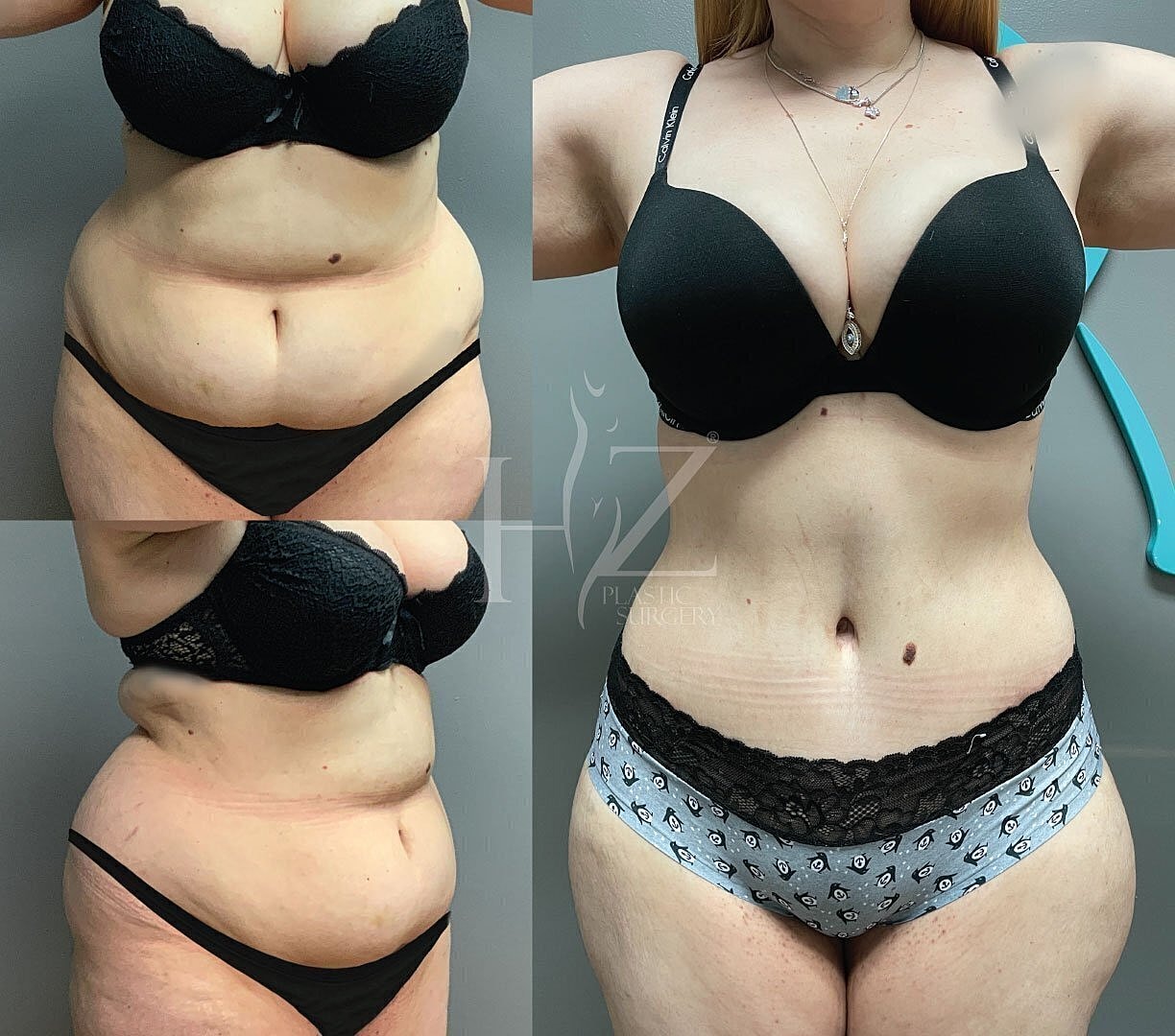 Body transformation before and after surgery.