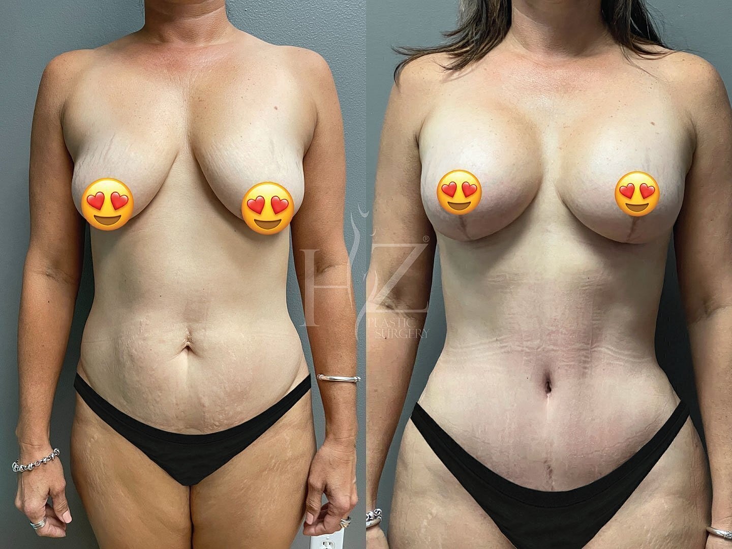 Before and after body transformation photos.