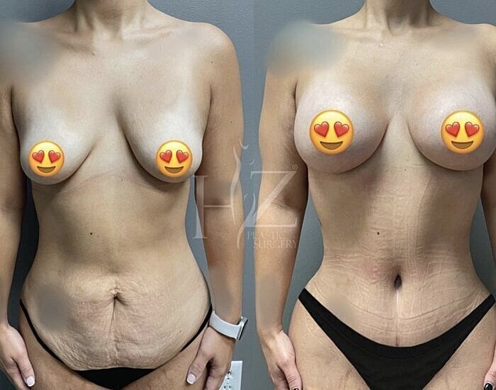 Plastic surgery before and after comparison image.