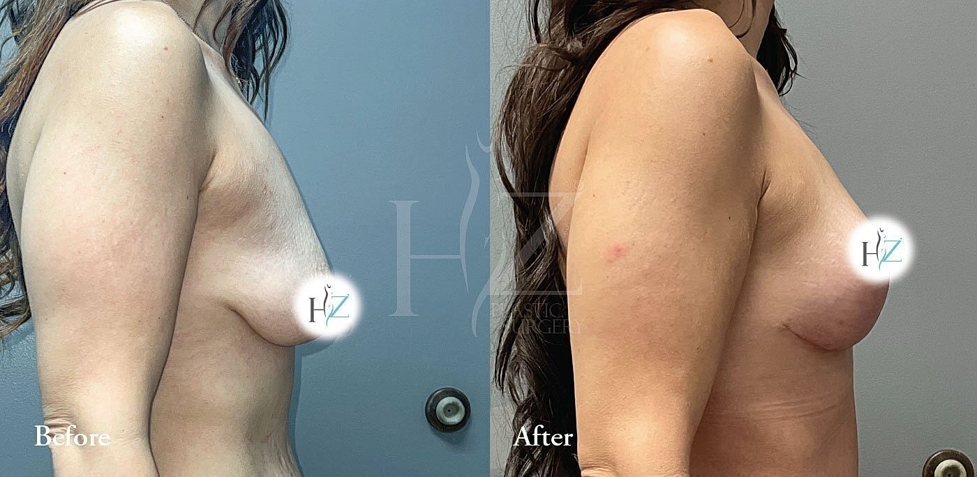 Before and after cosmetic surgery transformation.