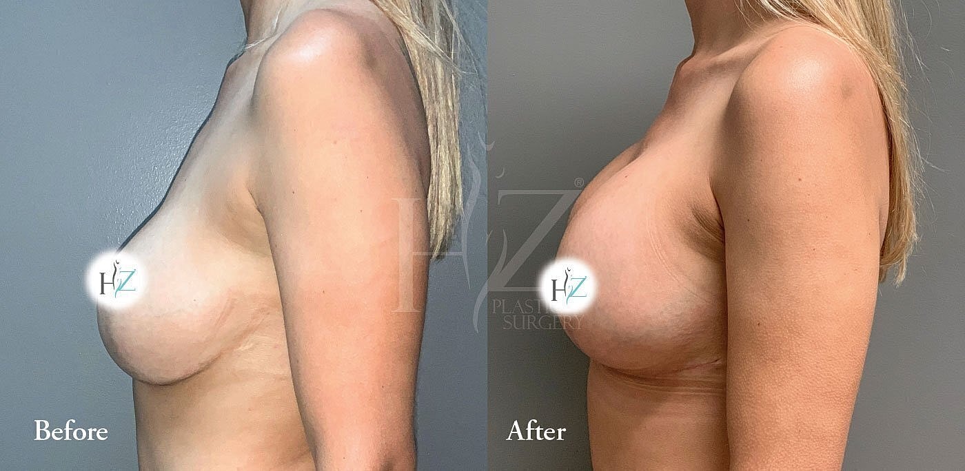Breast augmentation before and after comparison.