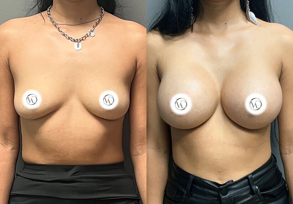 Before and after breast enhancement images.