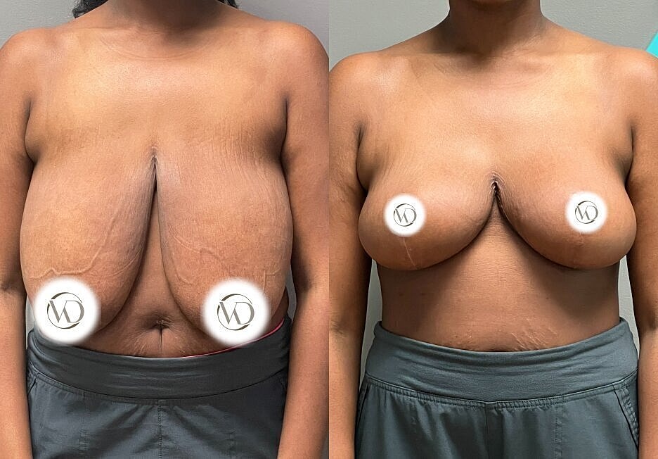 Before and after breast augmentation photos.