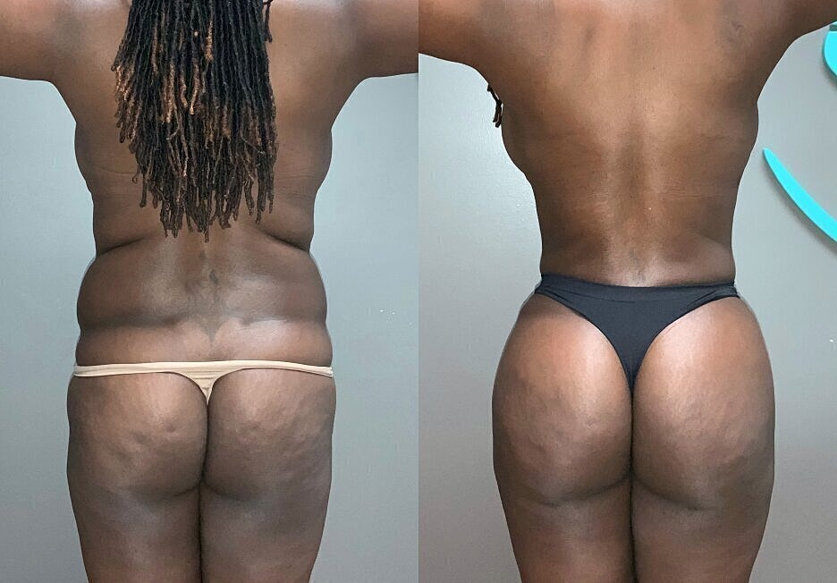 Before and after body transformation comparison.