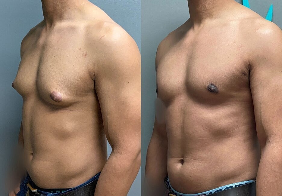Before and after comparison of chest appearance.