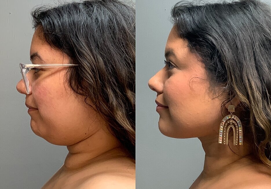 Profile comparison showing earrings and glasses.