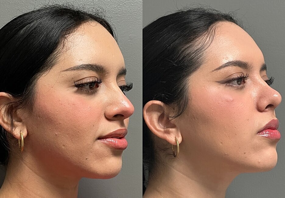 Profile comparison of a woman's face.