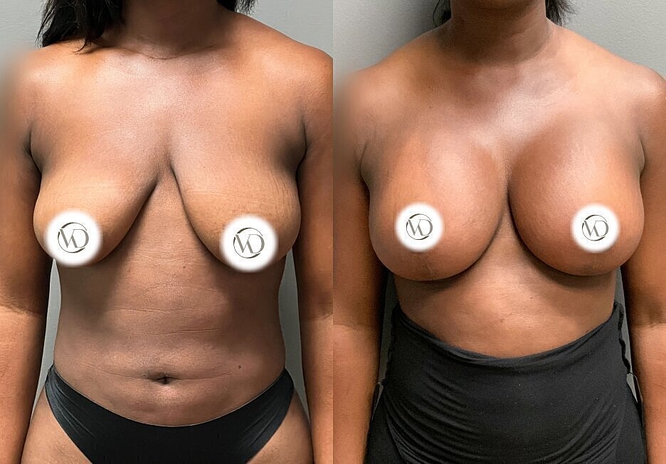 Before and after breast enhancement photos.