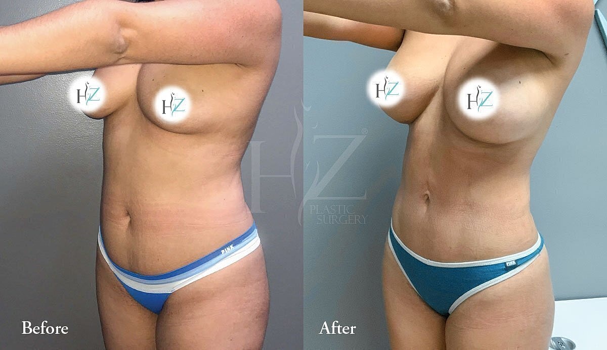 Plastic surgery before and after results comparison.