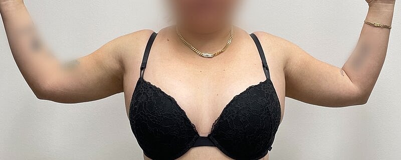 Liposuction Arms Before & After
