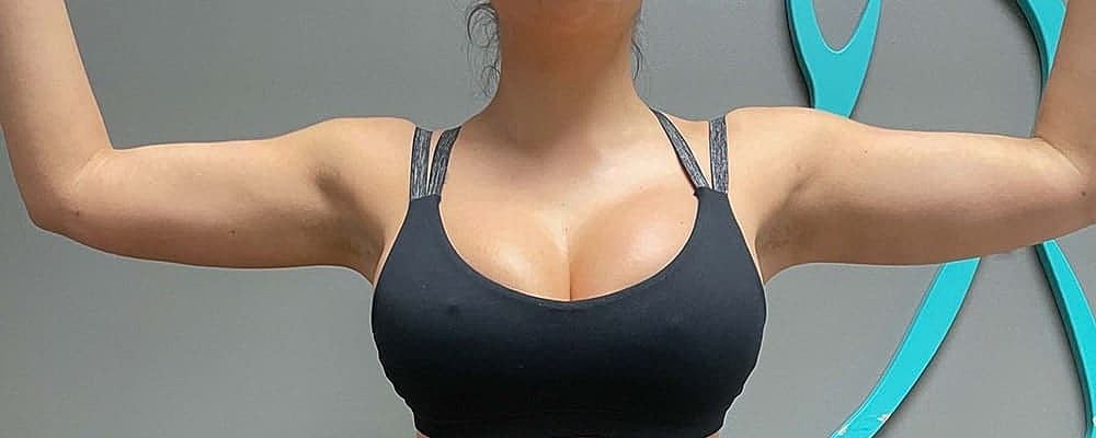 Liposuction Arms Before & After