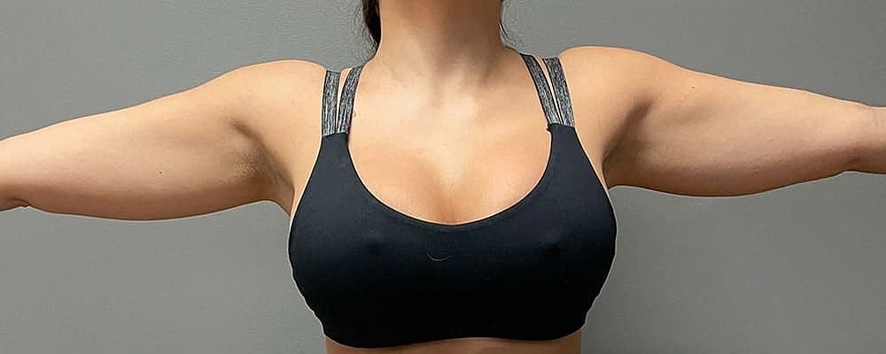 Liposuction Arms Before & After
