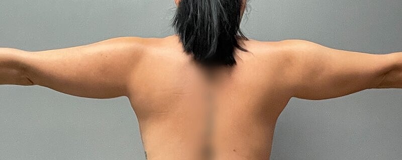 Liposuction Arms Before & After