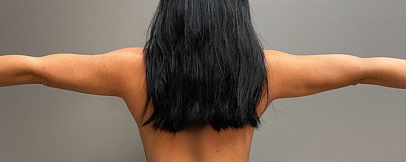Liposuction Arms Before & After