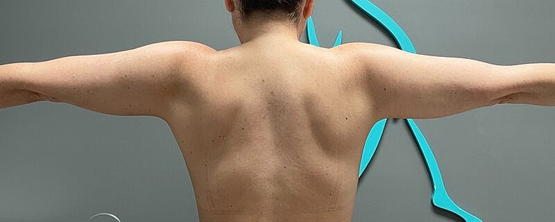 Liposuction Arms Before & After