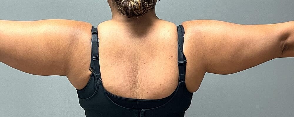 Liposuction Arms Before & After