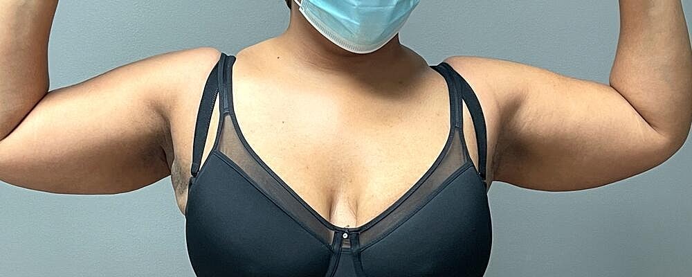 Liposuction Arms Before & After
