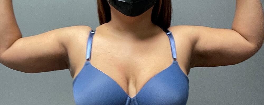 Liposuction Arms Before & After