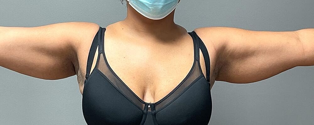 Liposuction Arms Before & After