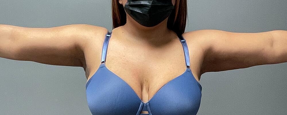 Liposuction Arms Before & After