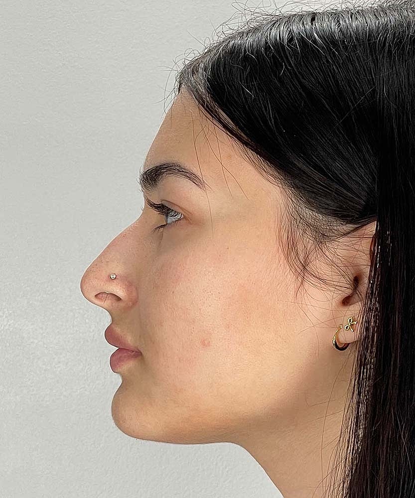 Rhinoplasty Before & After