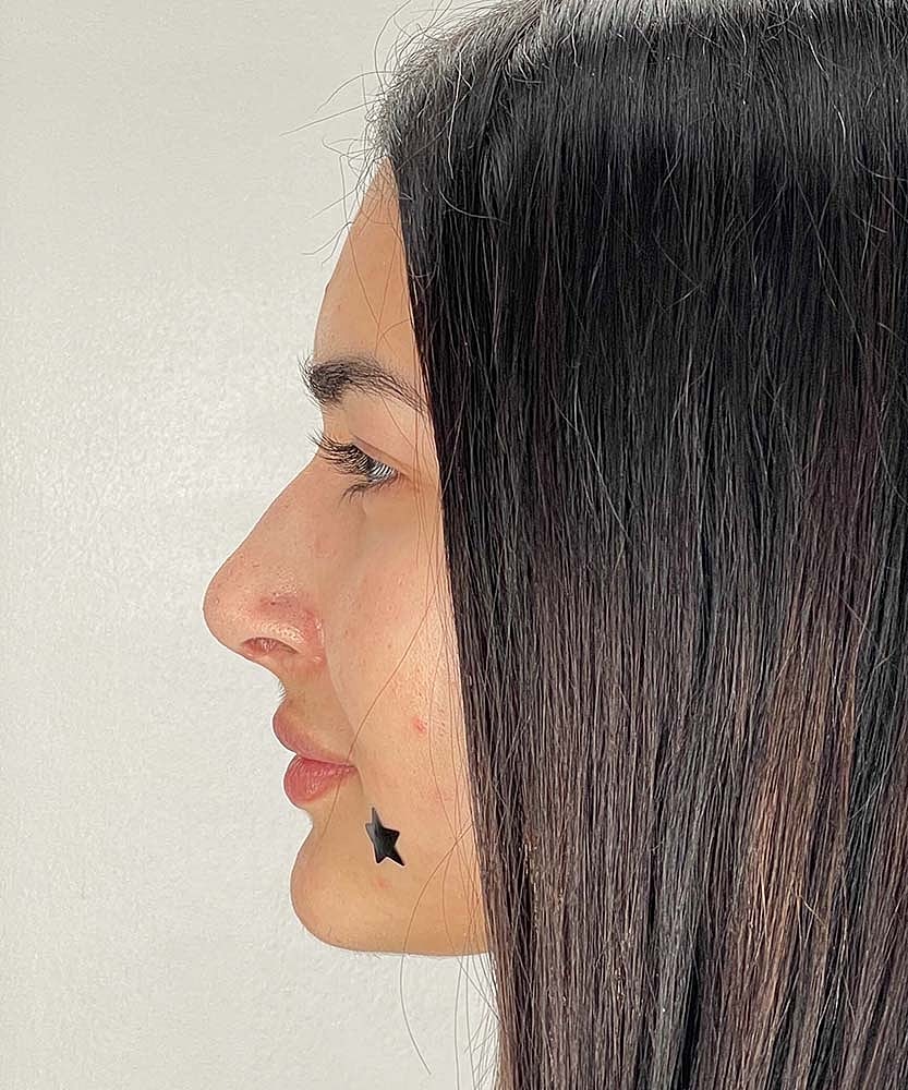 Rhinoplasty Before & After