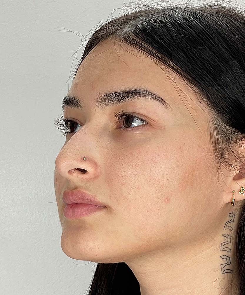 Rhinoplasty Before & After