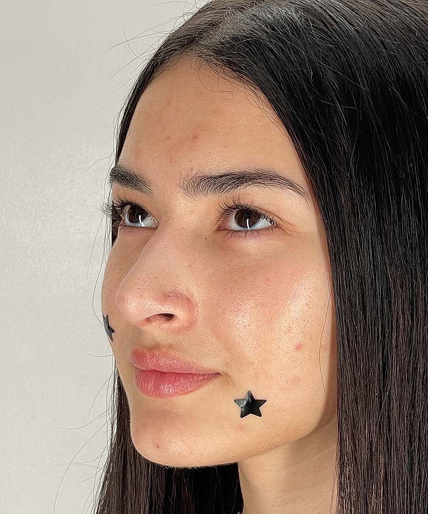 Rhinoplasty Before & After