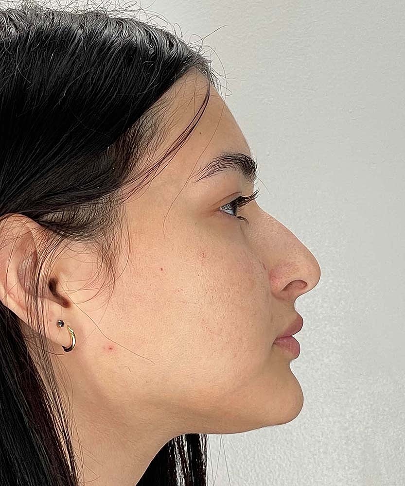 Rhinoplasty Before & After