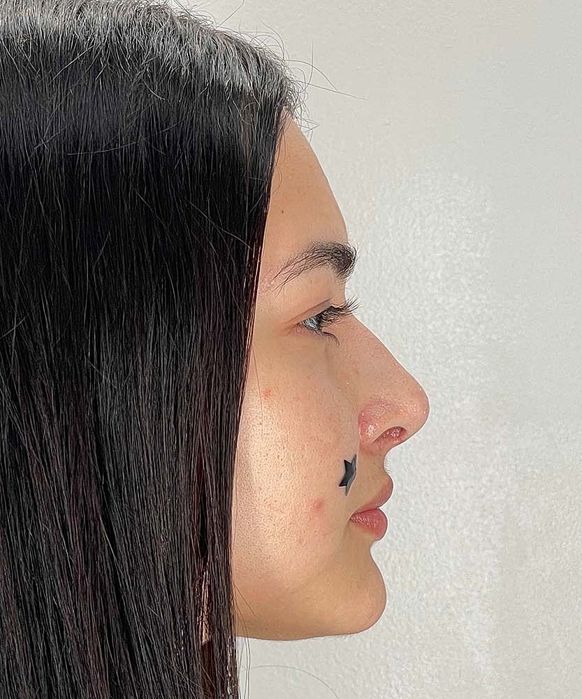 Rhinoplasty Before & After