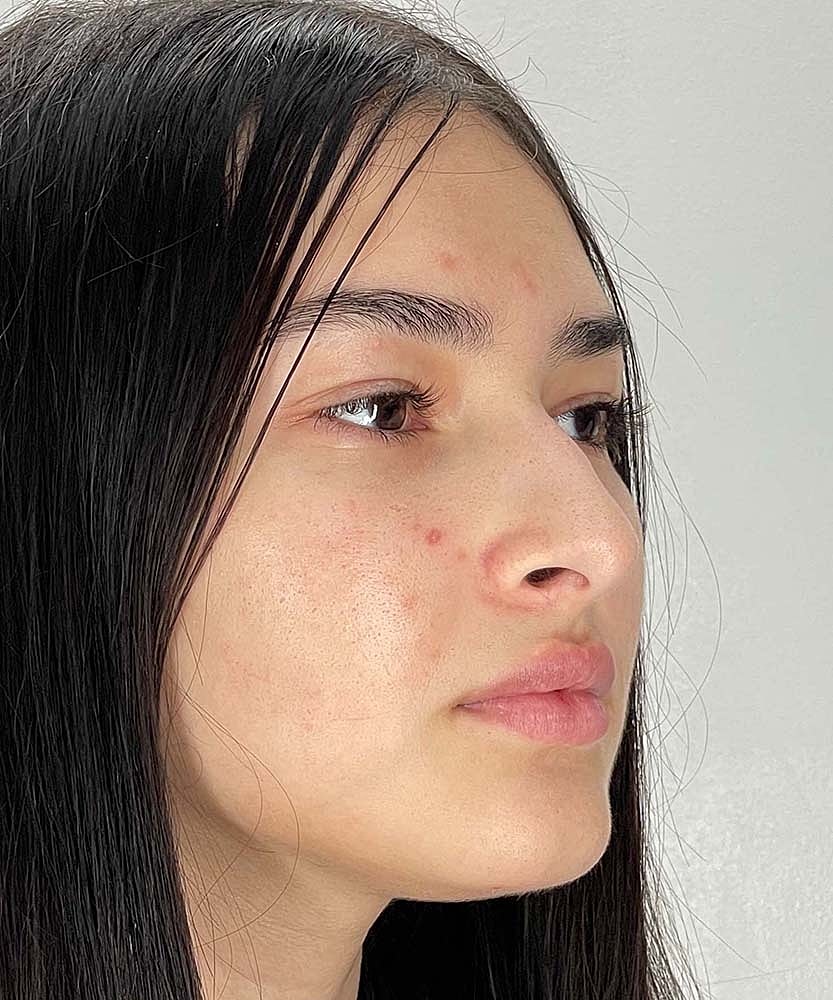 Rhinoplasty Before & After