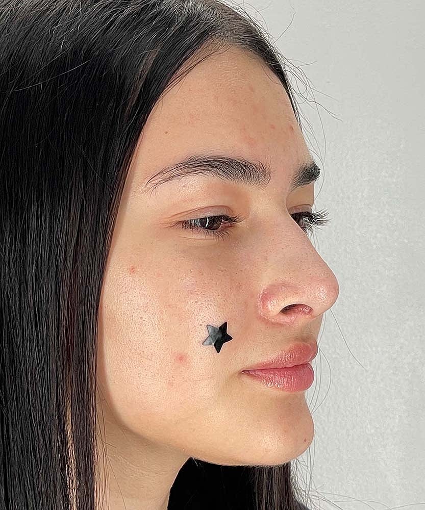 Rhinoplasty Before & After