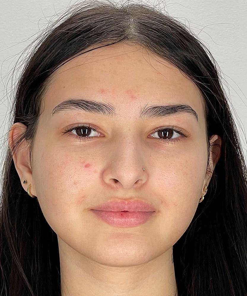 Rhinoplasty Before & After