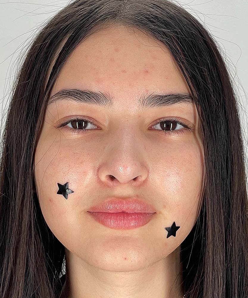 Rhinoplasty Before & After