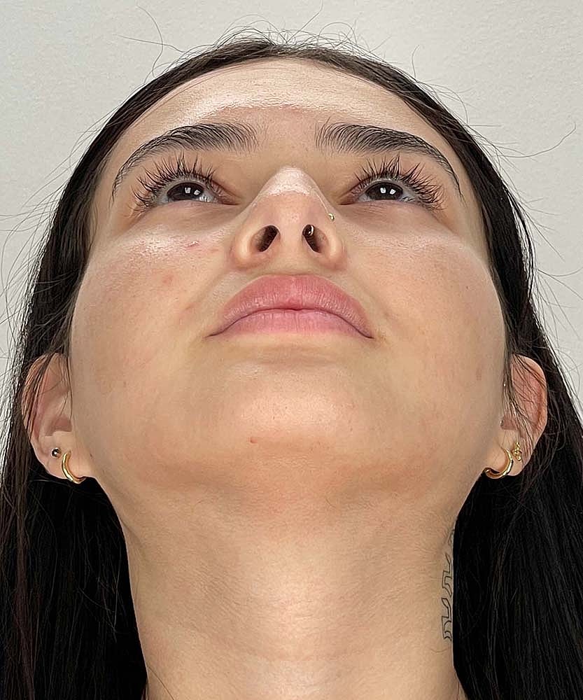 Rhinoplasty Before & After
